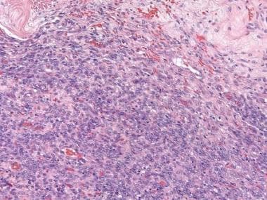 Endometrioid stromal sarcoma shows diffuse prolife
