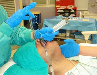 Once vocal cords are seen, endotracheal tube is ad