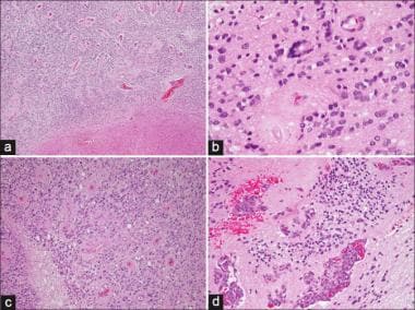 Anaplastic ependymoma. Note the numerous mitoses a