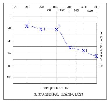 Audiogram depicting a high-frequency sloping senso
