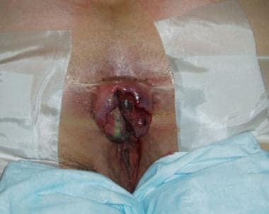 Anal Surgery for Hemorrhoids: Background, Indications, Contraindications