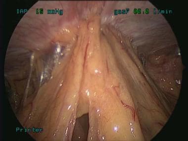 Small bowel adhesions to the periumbilical area an