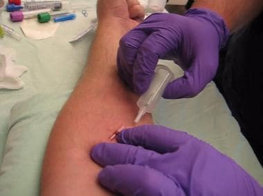 Using blood sampling adapter for IV cannulation. 