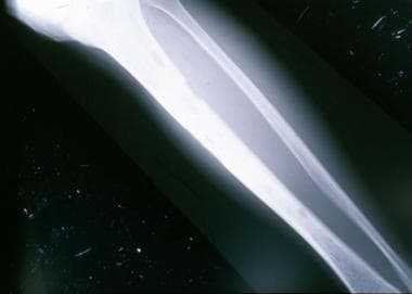Plain film of the tibia demonstrates small lucenci