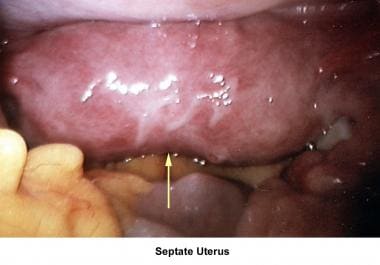 Infertility. Septate uterus. Image courtesy of Jai