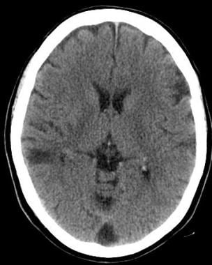 Magnetic resonance imaging. Large intracranial hemorrhage with moderate