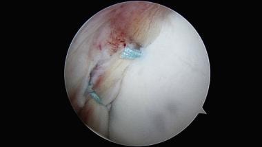 Next, with monofilament sutures and all-arthroscop