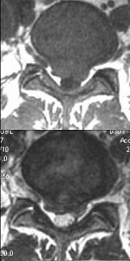 Axial T1- and T2-weighted images show moderate pos