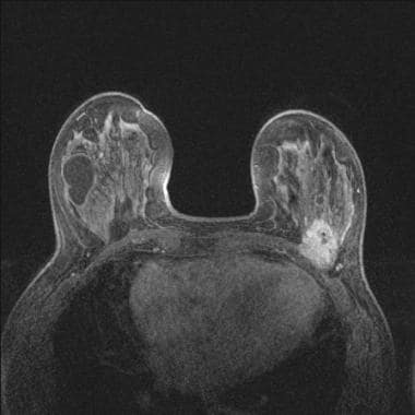 Mammography in Breast Cancer: Background, X-ray Mammography