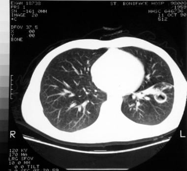 Chest CT reveals a thick wall cavity in the left l