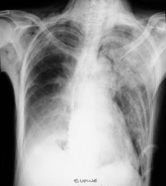 Chest radiograph in a man with blunt thoracic trau