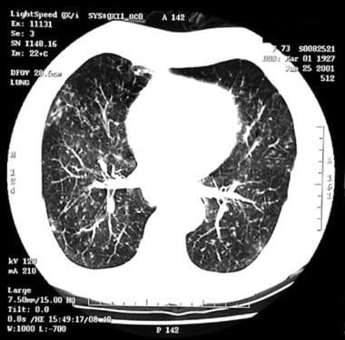 CT scan obtained in a patient with an infection du