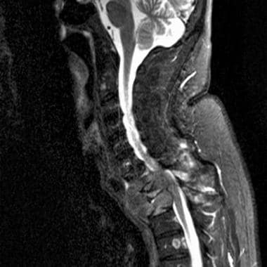 Pancoast tumor. Sagittal gradient-echo T2-weighted