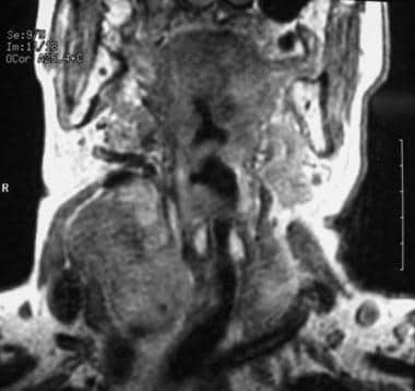 甲状腺髓样癌的MRI。