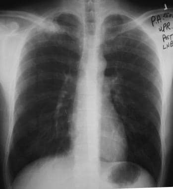 Solitary pulmonary nodule. Special attention must 
