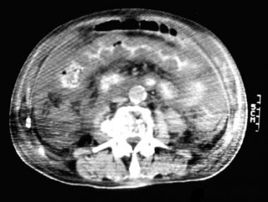 CT scan in a patient with pseudomembranous colitis
