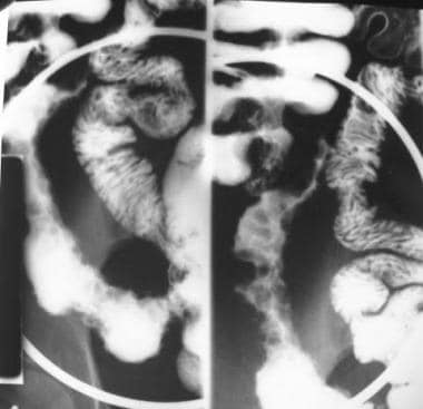 Crohn disease. Cobblestoning. Spot view of the ter
