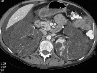CT scan of a patient with pancreas divisum. Sequen