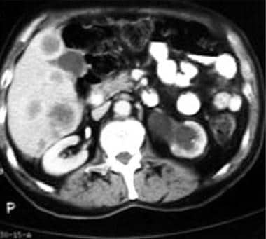 CT scan demonstrating metastases in the right lobe
