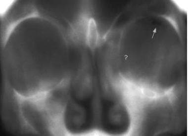 Conventional frontal tomograph of a blow-out fract