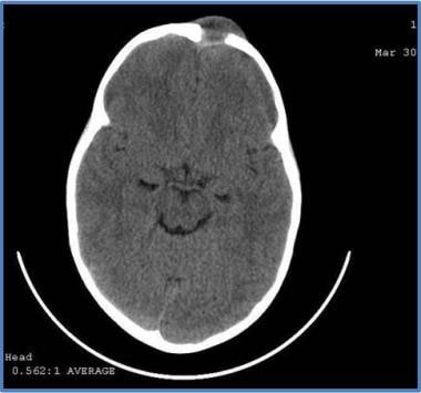 CT image of a 4-year-old boy with long-standing (1