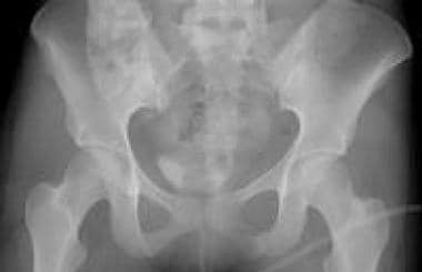 The combination of a sacral buckle fracture and ip