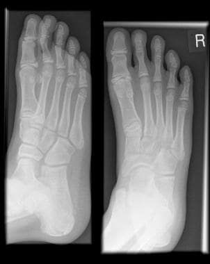 Fractured metatarsals. Transverse fracture at the 