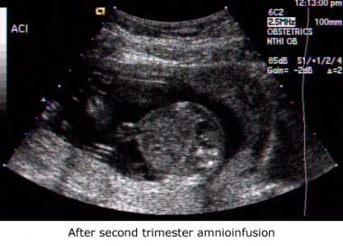 Sonogram obtained after second-trimester amnioinfu