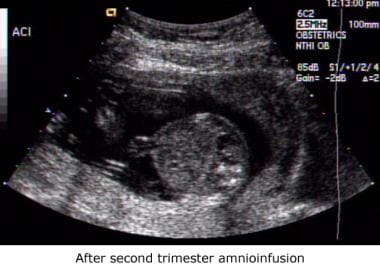 low amniotic fluid ultrasound