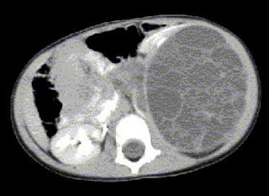 Multilocular cystic nephroma. CT shows a normal ri