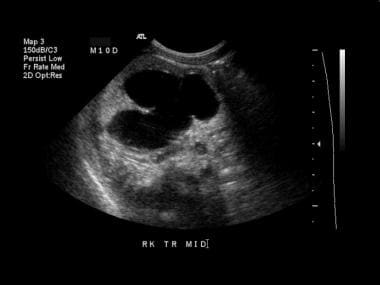 Transverse view of the right kidney demonstrates t