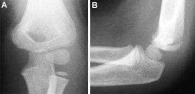 Lateral condyle fracture. Anteroposterior (A) and 