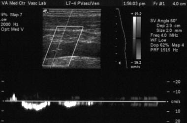 Superior vena cava syndrome (case 1, cont'd). Sono