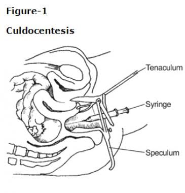 Culdocentesis procedure. 
