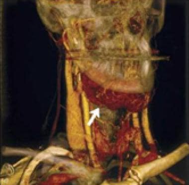 Three-dimensional CT angiogram of a submental vasc