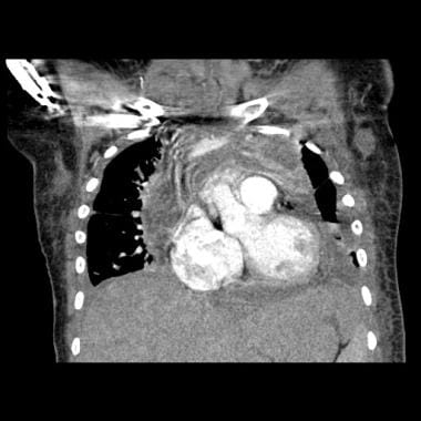 Coronal CT image of a 16-year-old adolescent with 