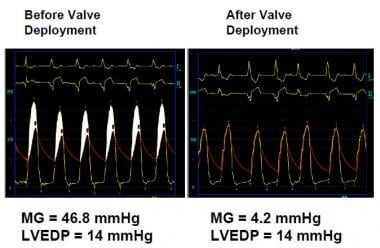 Transcatheter Aortic Valve Replacement (TAVR). Sim