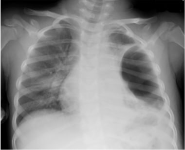 Tension pneumothorax in an infant.
