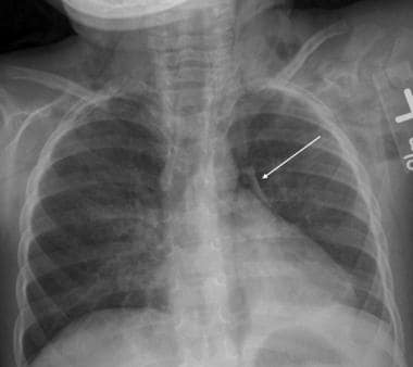 This chest radiograph (posteroanterior and lateral