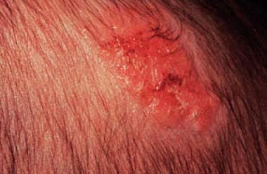 Lesion on the scalp of an infant. 