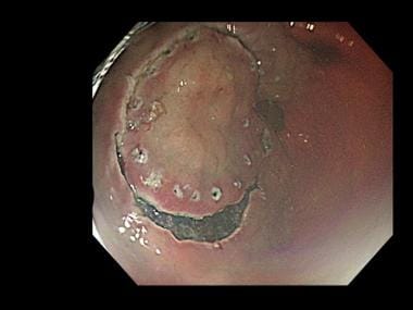 Endoscopic submucosal dissection (ESD). Circumfere
