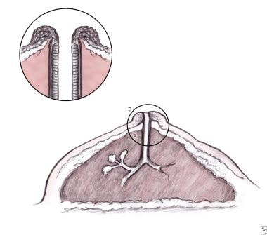 Nipple adenoma in a female patient presenting with persistent