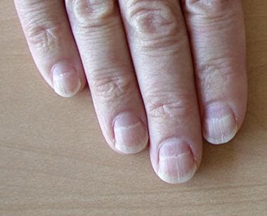 vertical lines on nails