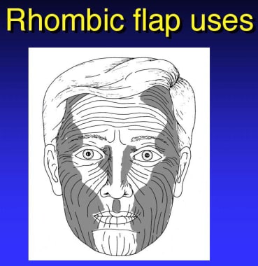 Rhombic flap uses. 