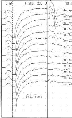 Prolonged F wave latencies (normal is &lt; 31). 
