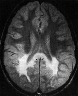 MRI of a patient with adrenoleukodystrophy showing