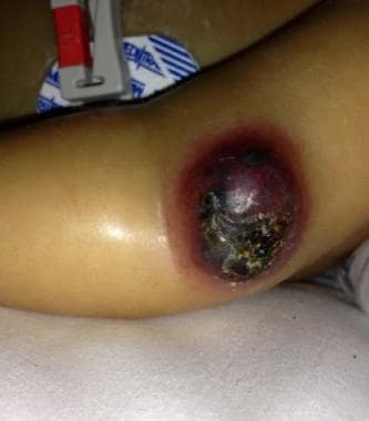 Hemangioma of arm in aforementioned patient with d