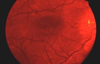 Fundus photograph of juvenile retinoschisis demons