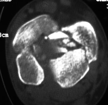 CT scan showing axial cut of pilon fracture. 