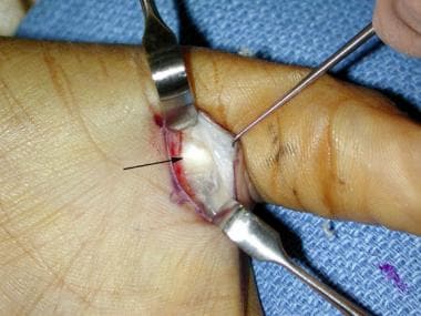 Trigger thumb. A1 pulley exposed within surgical f
